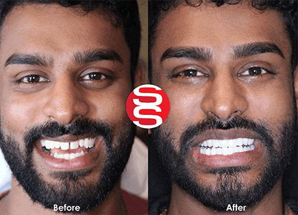 Porcelain Veneers